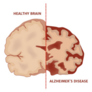 Alzheimers Disease Medical Brain Poster Sticker