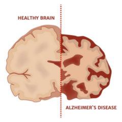 Alzheimers Disease Medical Brain Poster Sticker