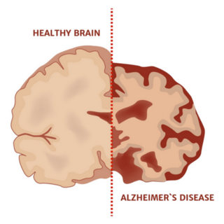 Alzheimers Disease Medical Brain Poster Sticker