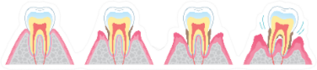 Illustration Of Periodontal Disease Dentist Sticker