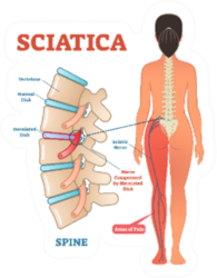 Sciatica Medical Health Care Lower Spine Sticker
